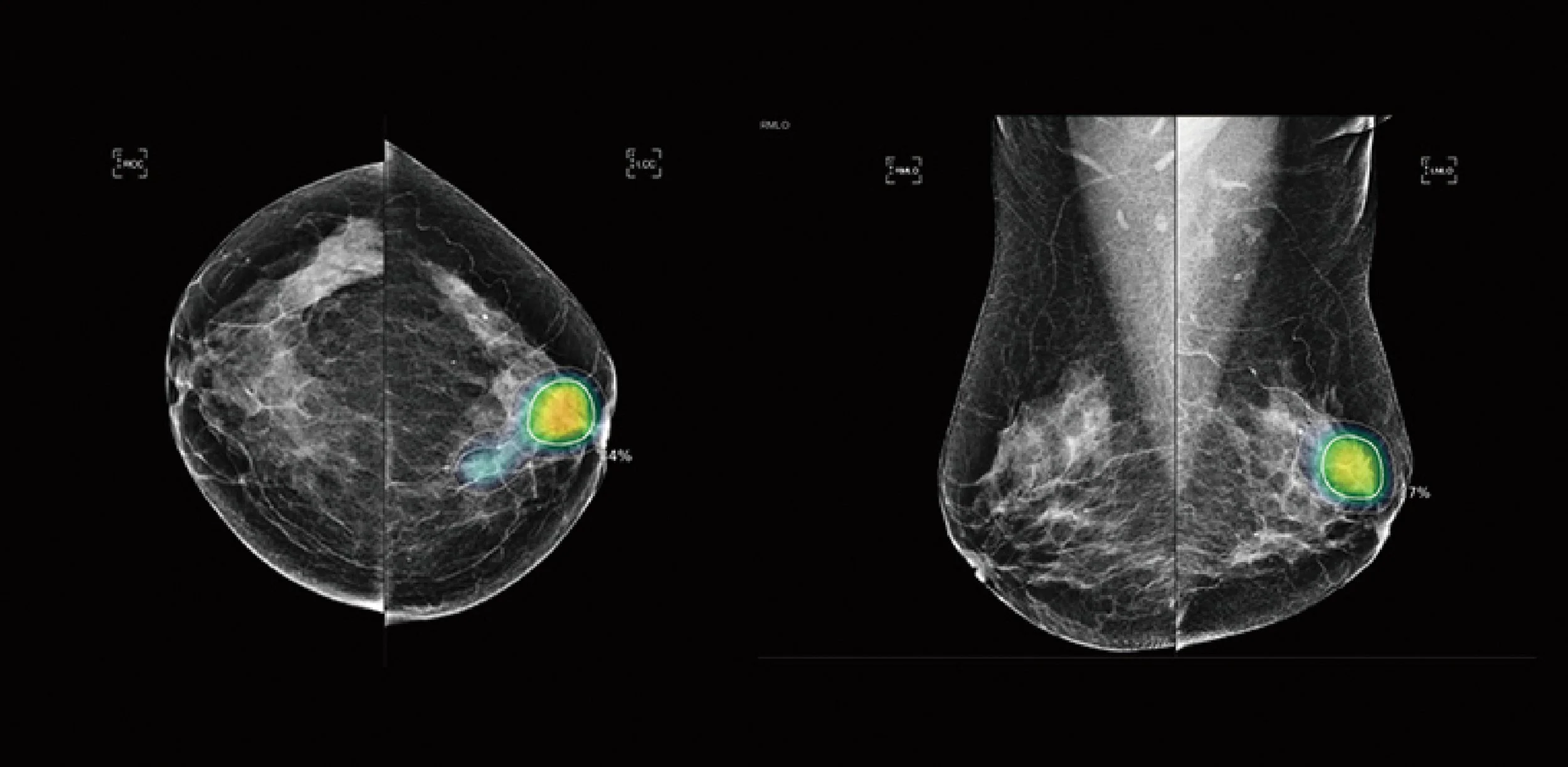 Women's Imaging Services | Second Read | Artificial Intelligence